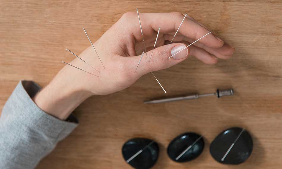 Traditional Chinese Acupuncture