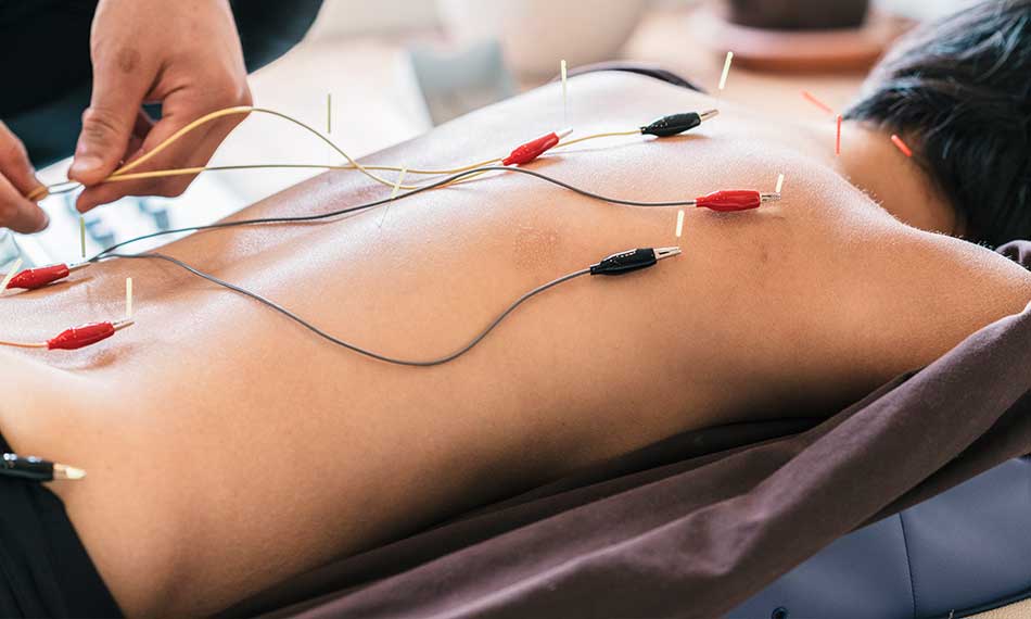 Electro-Acupuncture