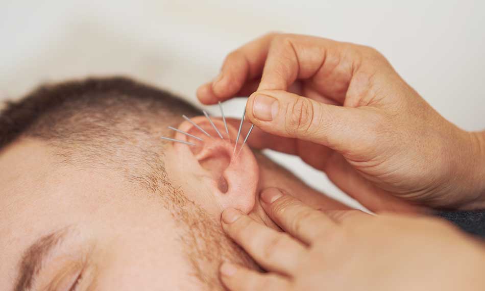 Auricular (Ear) Acupuncture