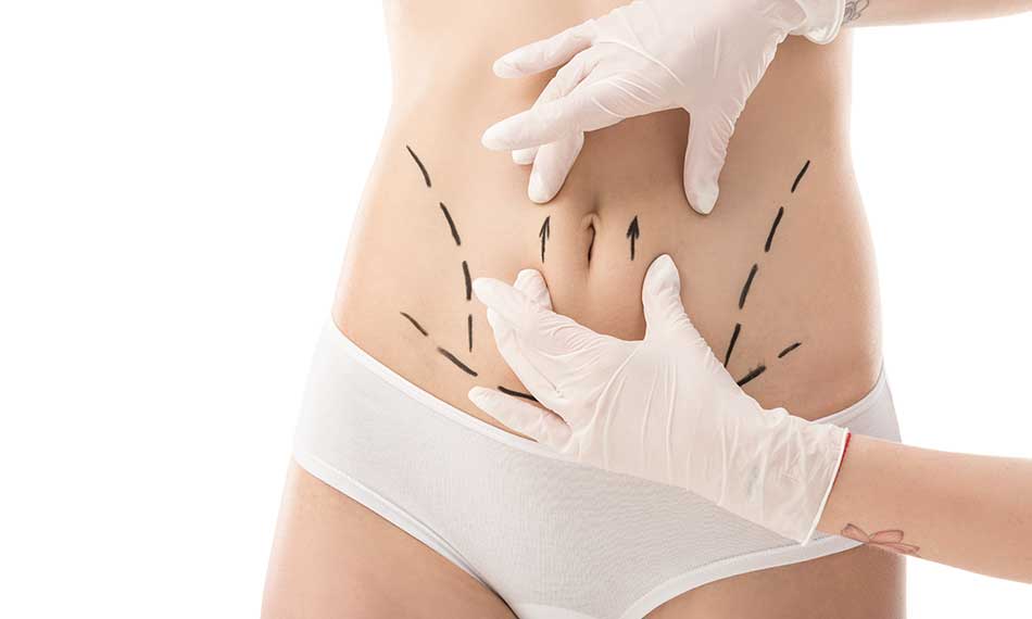 Tummy Tuck (Abdominoplasty)