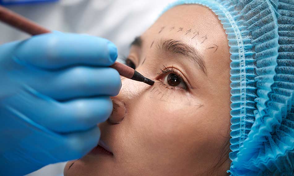 Eyelid Surgery (Blepharoplasty)